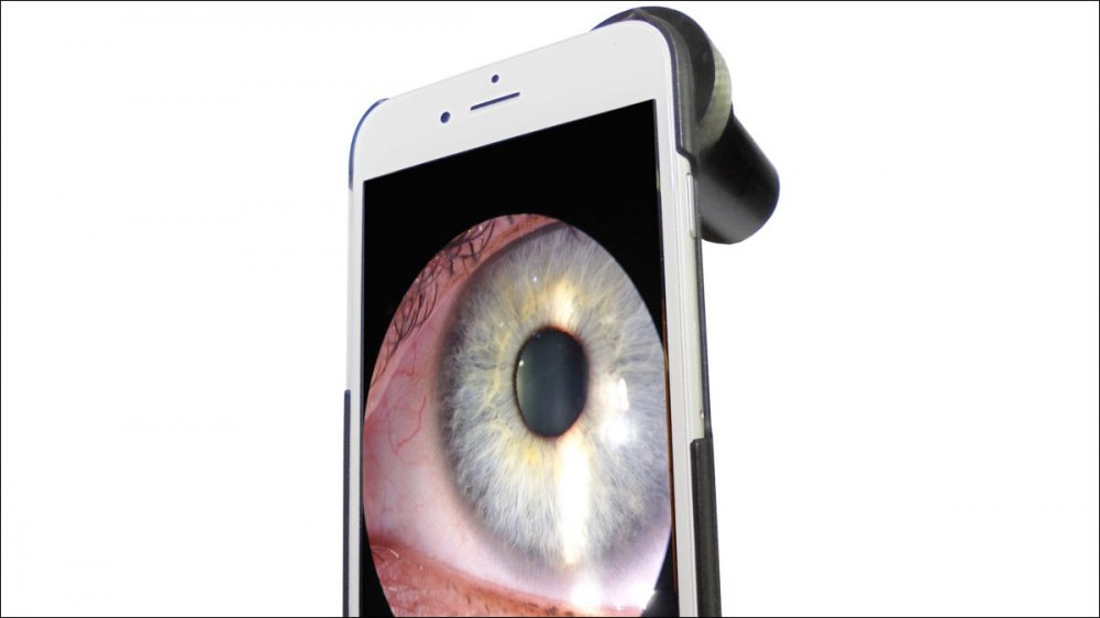 iPhone Slit Lamp